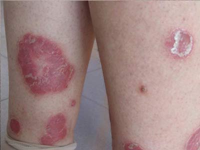 皮肤病秋冬易加重感冒是主谋